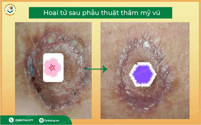 xử lý hoại tử sau mổ