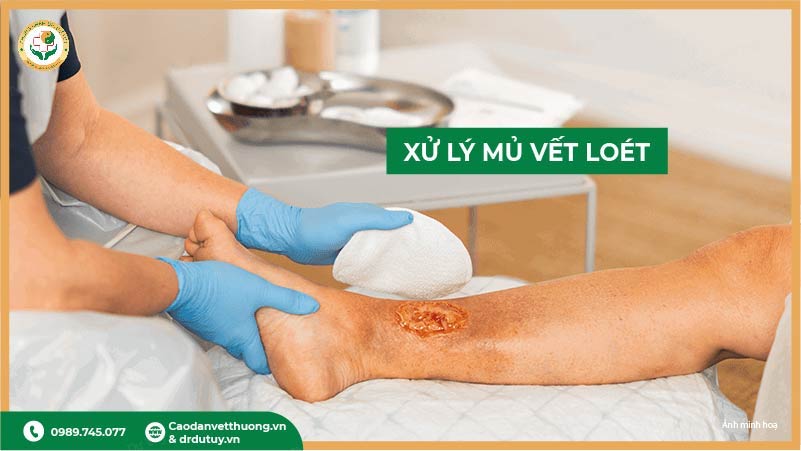 xử lý mủ vết loét tì đè