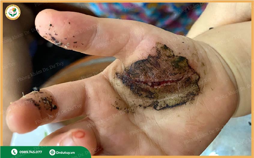 xử lý vết cắt ở trẻ tại nhà