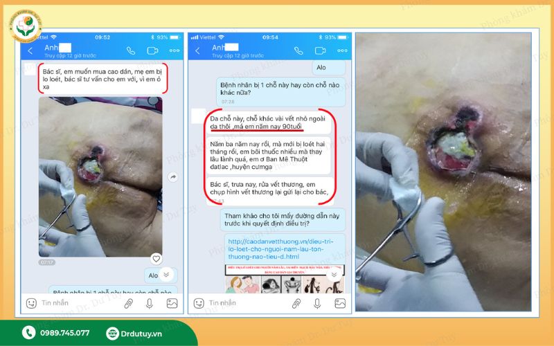 xử lý vết loét vùng cùng cụt