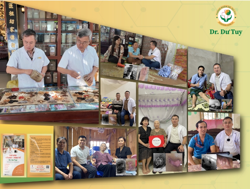 xử lý vết loét vùng cùng cụt