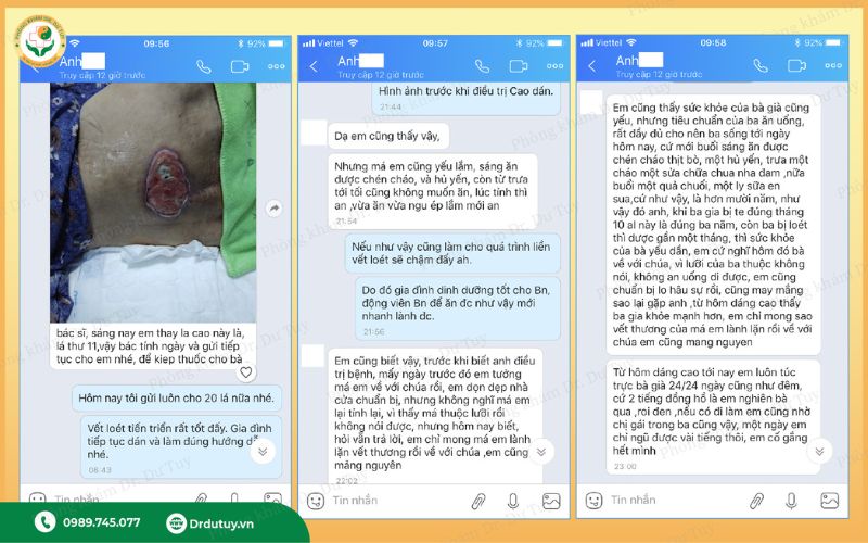 xử lý vết loét vùng cùng cụt