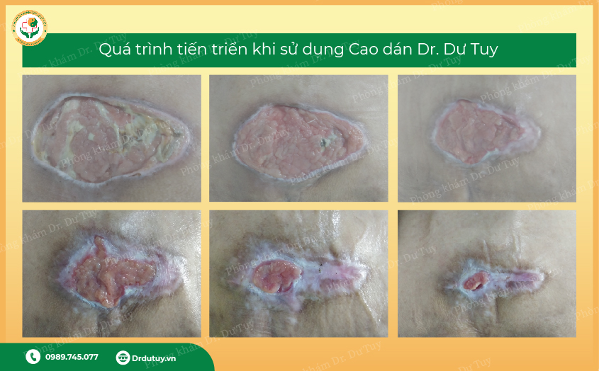 xử lý vết loét vùng cùng cụt