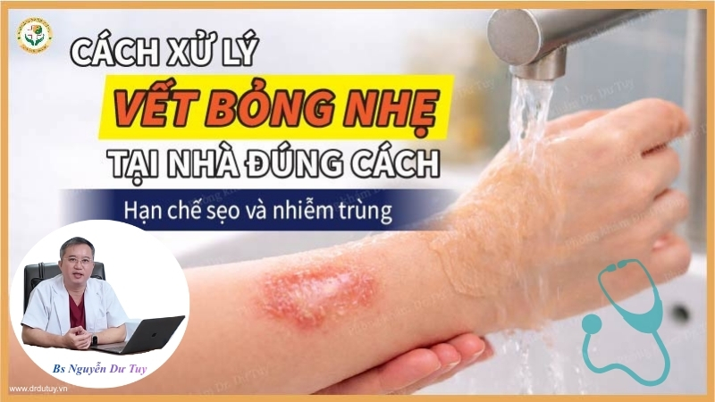 Cách xử lý vết bỏng nhẹ tại nhà đúng cách, hạn chế sẹo và nhiễm trùng