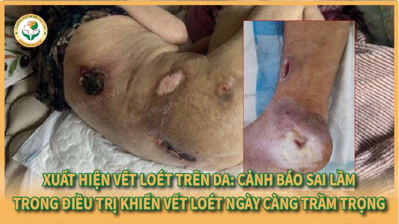 Xuất hiện vết loét trên da: Cảnh báo sai lầm trong điều trị khiến vết loét ngày càng trầm trọng
